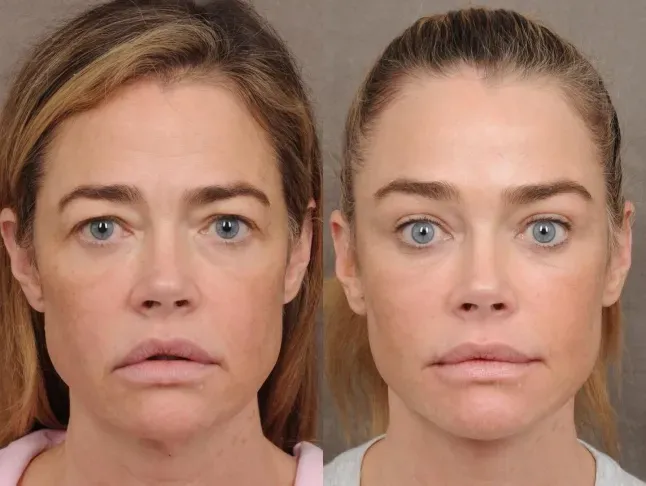 Denise Richards Makes First Appearance Post-Facelift: New Look and Reactions - Image 2