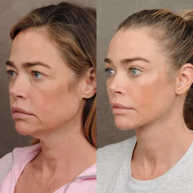 Denise Richards Makes First Appearance Post-Facelift: New Look and Reactions - Image 4